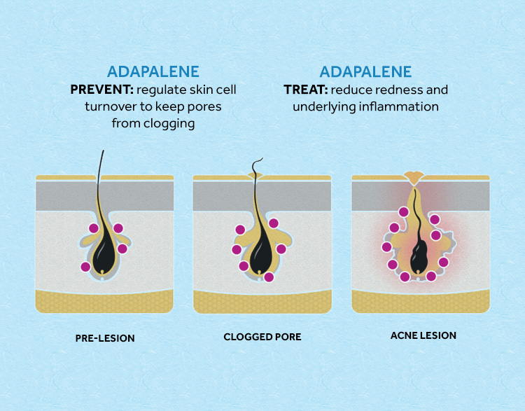 Pre-Lesion, clogged pore, and acne lesion