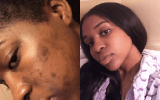 Differin real before and after acne treatment results - Example 2